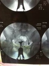 试管婴儿成功后这些问题一定不能忽视